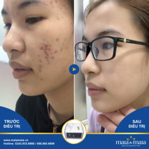 Những sai lầm khi điều trị mụn trứng cá