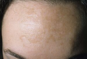 Nám da xuất hiện trong thời kỳ thai kỳ thường mờ nhạt