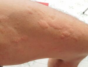 Mề đay có thể xuất hiện ở bất cứ vùng da nào
