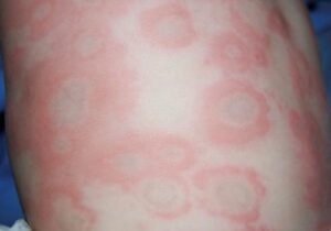 Mề đay ngứa gây ra rất nhiều phiền toái và ảnh hưởng đến cuộc sống