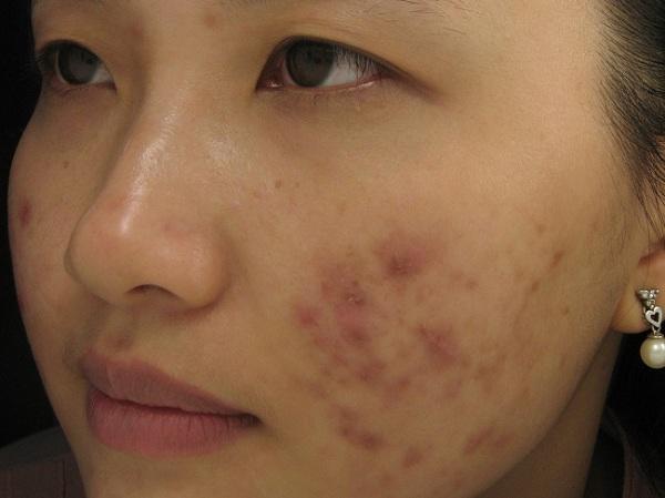 Sử dụng sản phẩm kém chất lượng cũng có thể dẫn đến mụn trứng cá