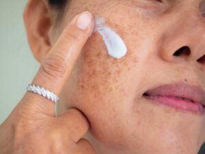 Sử dụng thuốc bôi là một phương pháp điều trị nám phổ biến