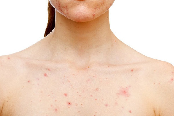 Cách điều trị mụn ở ngực mà chị em phụ nữ nên biết