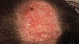 Hạn chế căng thẳng để tránh tình trạng bệnh lupus bùng phát