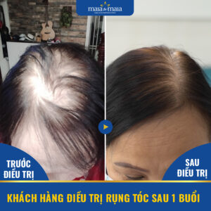 Hiệu quả sau khi điều trị rụng tóc bằng công nghệ cao tại Maia&Mái