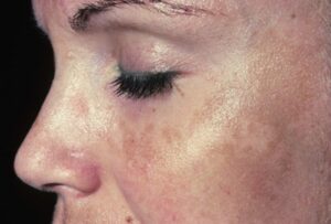 Nhiều người e ngại rằng thuốc có thể làm tình trạng trầm trọng hơn