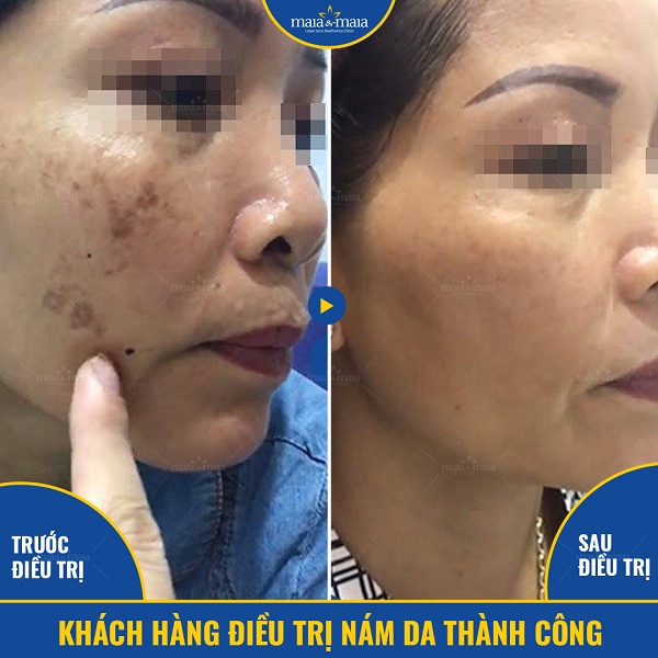 Nên thăm khám với bác sĩ da liễu để được tư vấn phương pháp điều trị nám phù hợp