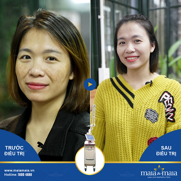 Thay bằng tinh dầu thì bạn có thể sử dụng công nghệ cao để trị nám