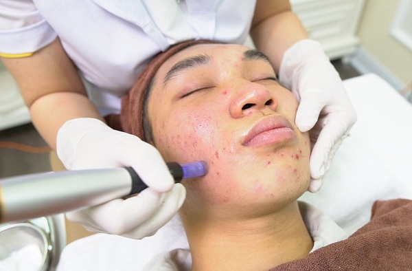 Lăn kim, phi kim giúp kích thích da sản sinh collagen nhằm lấp đầy sẹo rỗ