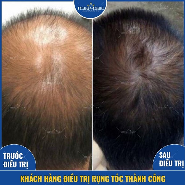 Điều trị chứng rụng tóc hói đầu ở nam giới bằng công nghệ Meso