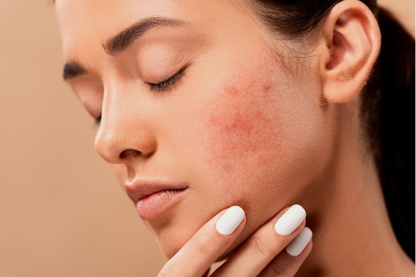 Nên điều trị sẹo rỗ sớm để đạt hiệu quả cao nhất