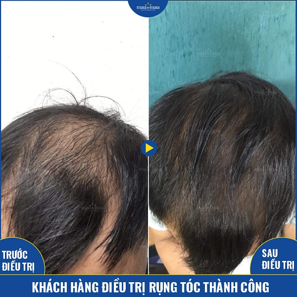 Khách hàng điều trị rụng tóc thành công nhờ sử dụng đa trị liệu tại Maia