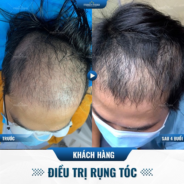 Hiệu quả cải thiện qua từng buổi của khách hàng tại phòng khám Maia