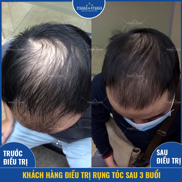 Tóc mọc trở lại sau khi sử dụng phương pháp đa trị liệu tại phòng khám
