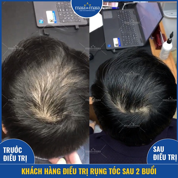 Hiệu quả điều trị rụng tóc kiểu hói nam tại phòng khám Maia