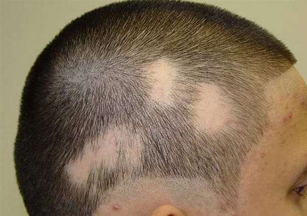 Bệnh tiểu đường thường gây nên chứng rụng tóc từng mảng