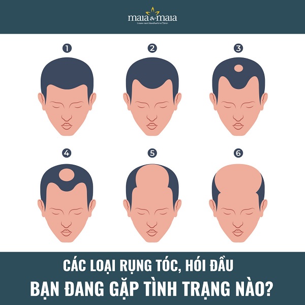 Đường chân tóc bị rút ngắn và hói dần ở nam giới