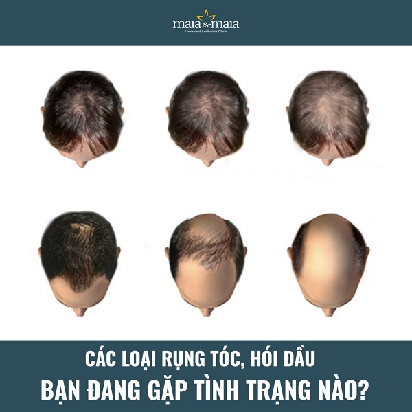 Chứng hói đầu bắt đầu từ thưa tóc ở đỉnh đầu