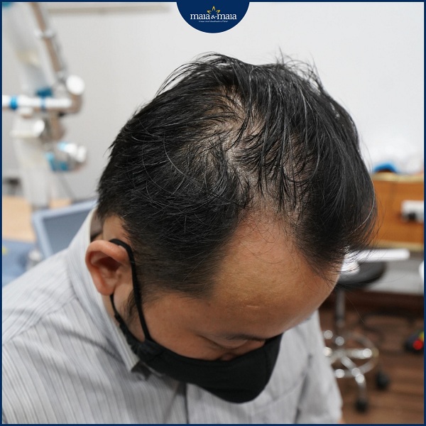 Tóc mỏng dần và dần tiến triển thành bị hói