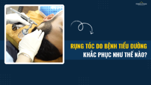 rung toc do benh tieu duong