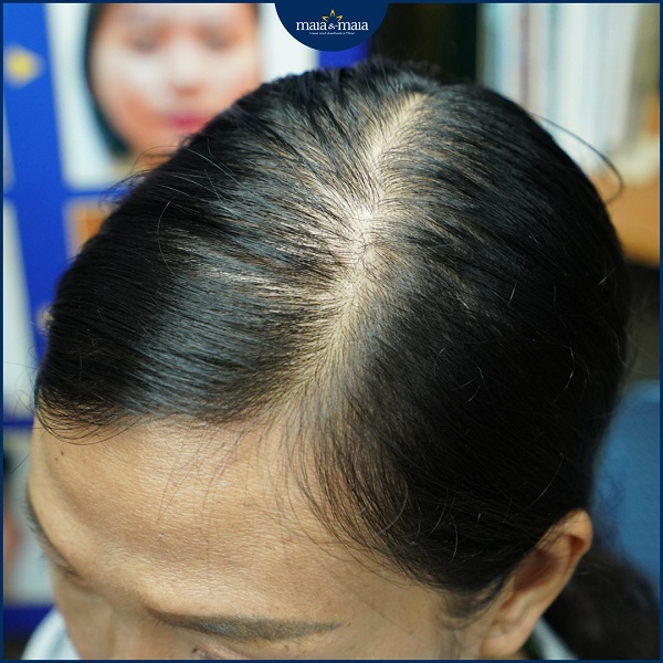 Tóc thưa do rụng tóc sau sinh