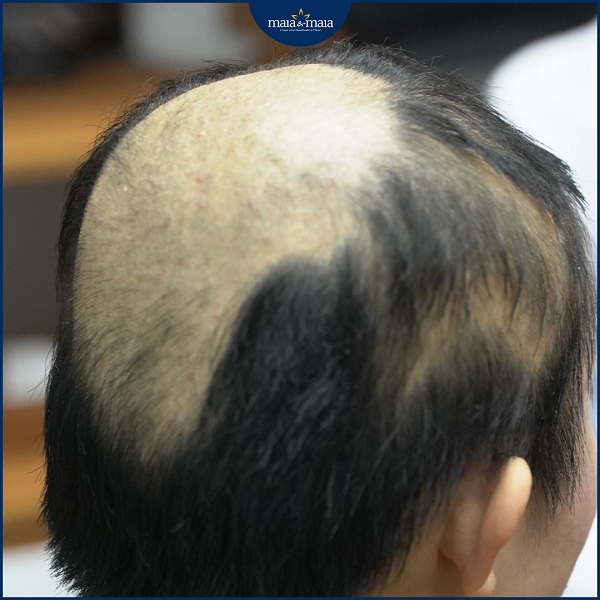 Không những tóc mỏng mà còn bị hói nếu như bị nấm da đầu