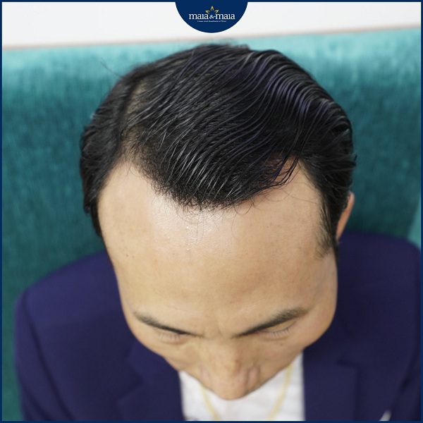 Rụng tóc gây hói đầu ở nam giới