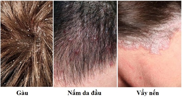 Một số nguyên nhân gây ngứa da đầu