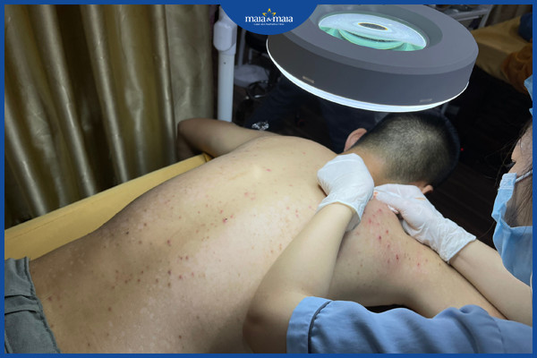 Cần loại bỏ nhân mụn trong quá trình điều trị