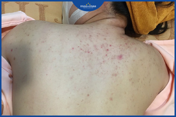Mụn trứng cá lưng do bít tắc nang lông