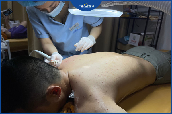 Điều trị mụn lưng tại phòng khám Maia&Maia