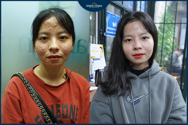 Hiệu quả sau khi điều trị mụn chuẩn y khoa tại phòng khám Maia