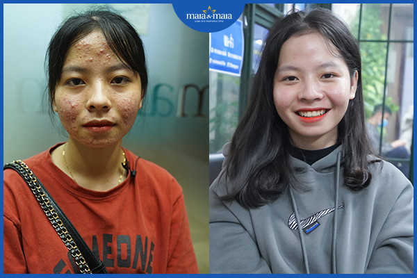 Hiệu quả điều trị mụn của khách hàng tại phòng khám Maia