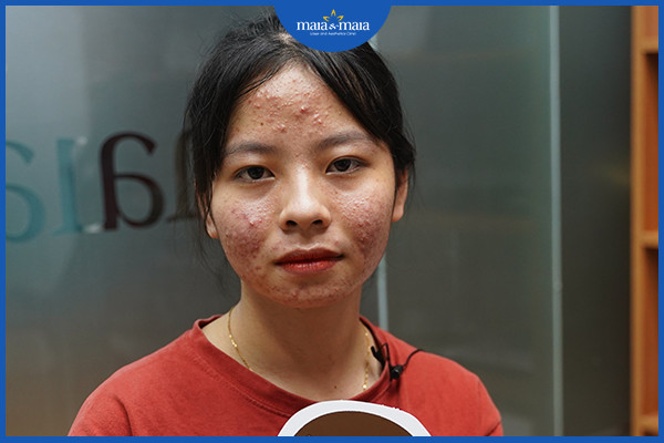 Điều trị mụn đầu đen không đúng cách có thể làm khởi phát các loại mụn nghiêm trọng hơn
