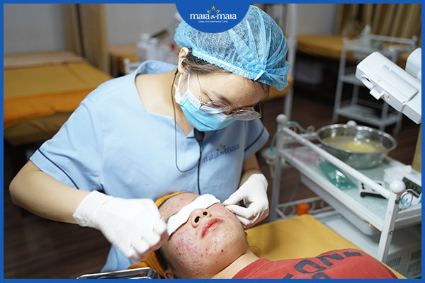 Loại bỏ nhân mụn đúng cách là một trong những bước trong điều trị mụn đầu đen