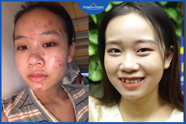 Hiệu quả điều trị mụn bằng công nghệ cao tại phòng khám Maia