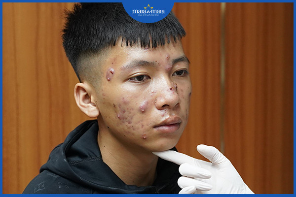 Không điều trị mụn nang đúng cách có thể gây tổn thương nặng nề trên da