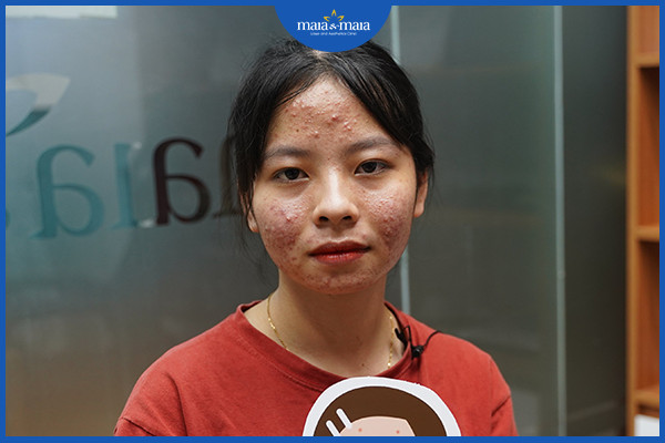 Một số sản phẩm bôi ngoài da có thể giúp cải thiện tình trạng mụn viêm