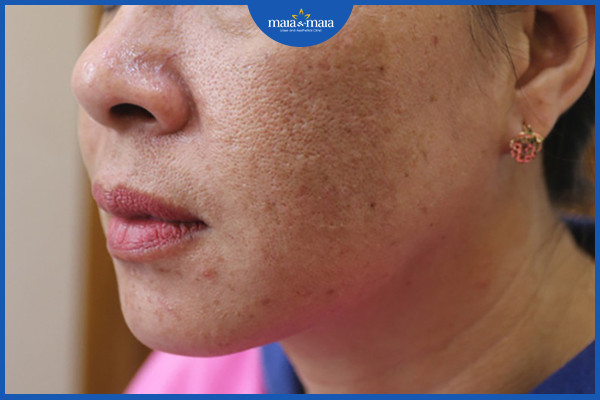 Retinoids có thể làm mờ sắc tố da như nám, tàn nhang