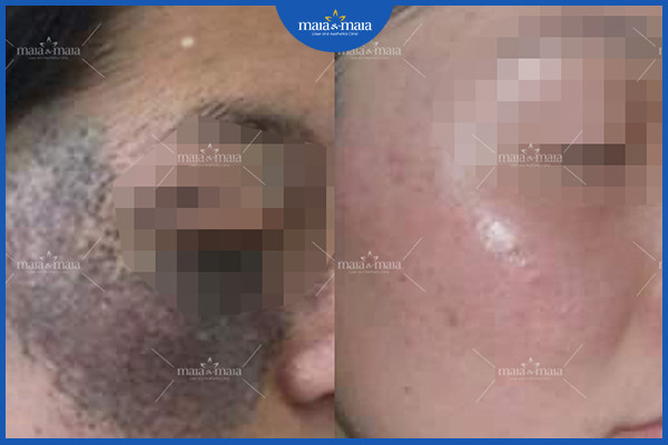 Hiệu quả điều trị bớt sắc tố tại phòng khám Maia