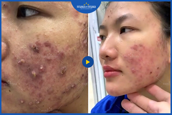 Cần kiểm soát các yếu tố gây bệnh để cải thiện tình trạng mụn trứng cá