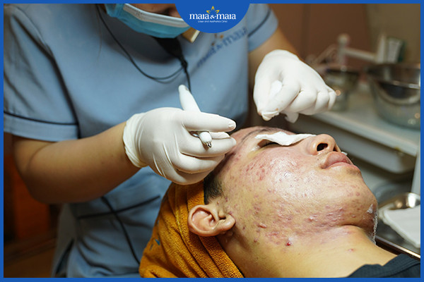 Sử dụng Laser Diot để hỗ trợ trị mụn tại phòng khám Maia