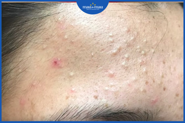 Mụn ẩn hay còn gọi là mụn đầu trắng