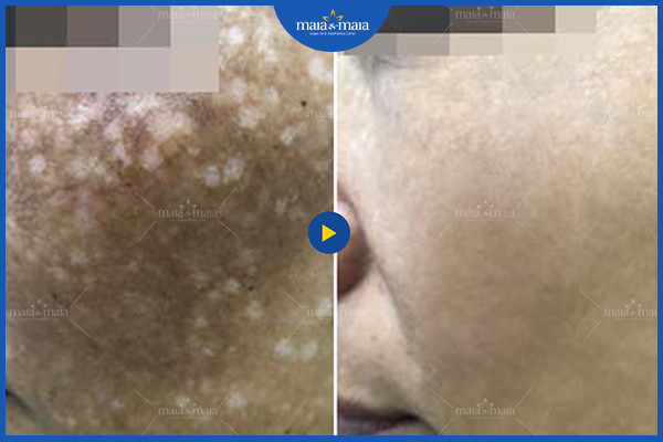 Hiệu quả sau liệu trình điều trị rám má