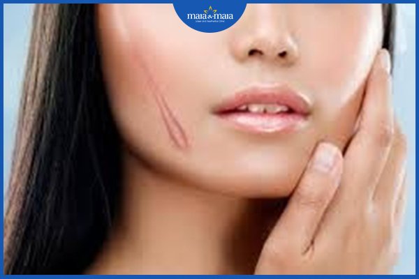 Cách trị sẹo lồi mới hình thành