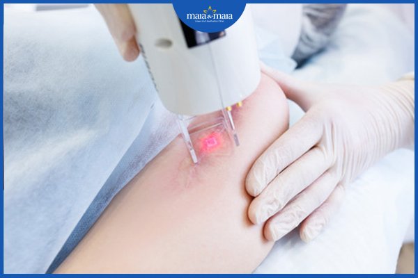 Điều trị sẹo lồi bằng laser