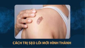 Cách trị sẹo lồi mới hình thành