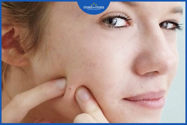 Có nên nặn mụn ẩn không?