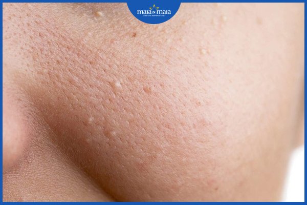 Có nên nặn mụn ẩn không?