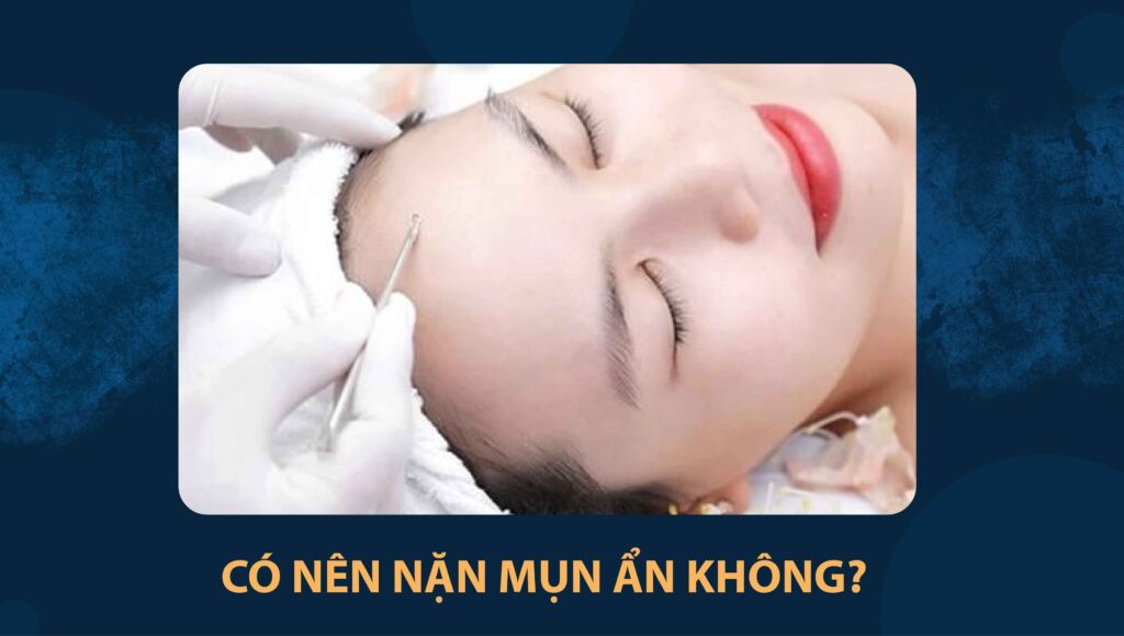 nặn mụn ẩn